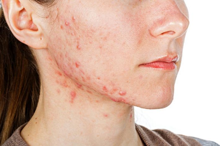 why PCOS can cause acne