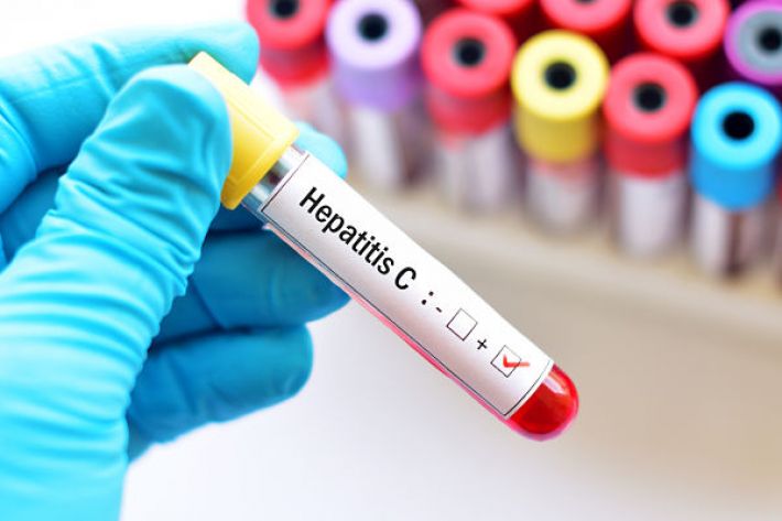 Hepatitis C and Hypothyroid