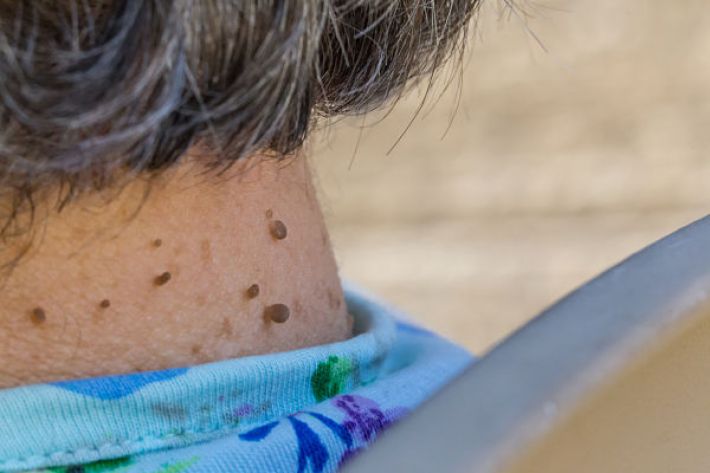 skin tags may warn of insulin resistance