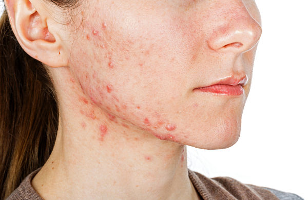 why PCOS can cause acne