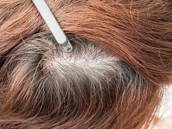 the-first-signs-of- female-pattern-hair-loss